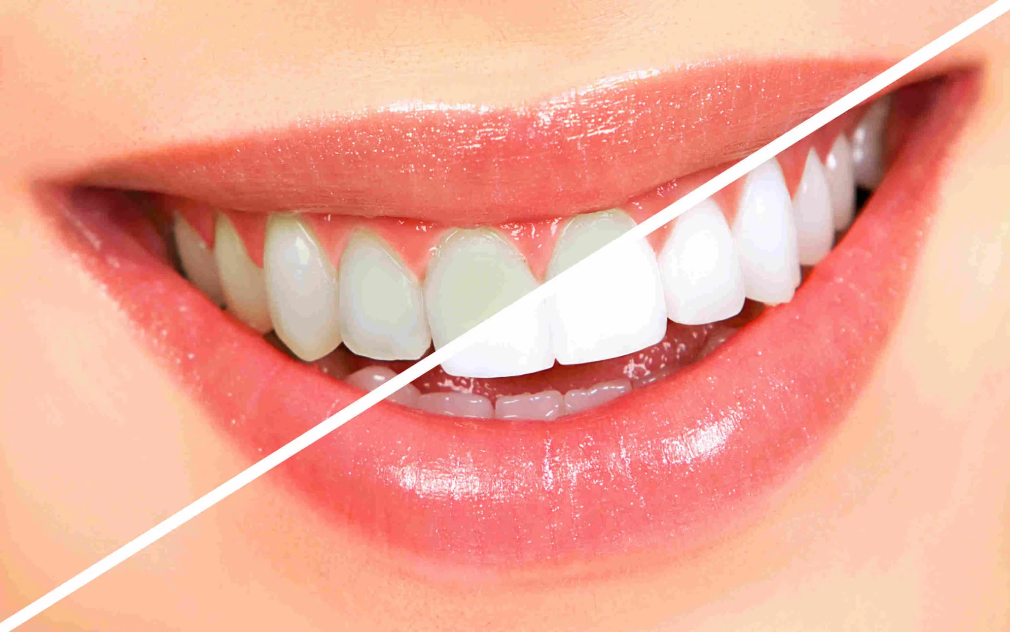 Patient heureux avec un Hollywood Smile à Tanger