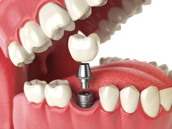 Implantologie Dentaire à Tanger – Remplacement des Dents avec Dr Haitham
