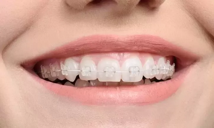 Bagues dentaires prix Maroc – orthodontie à Tanger