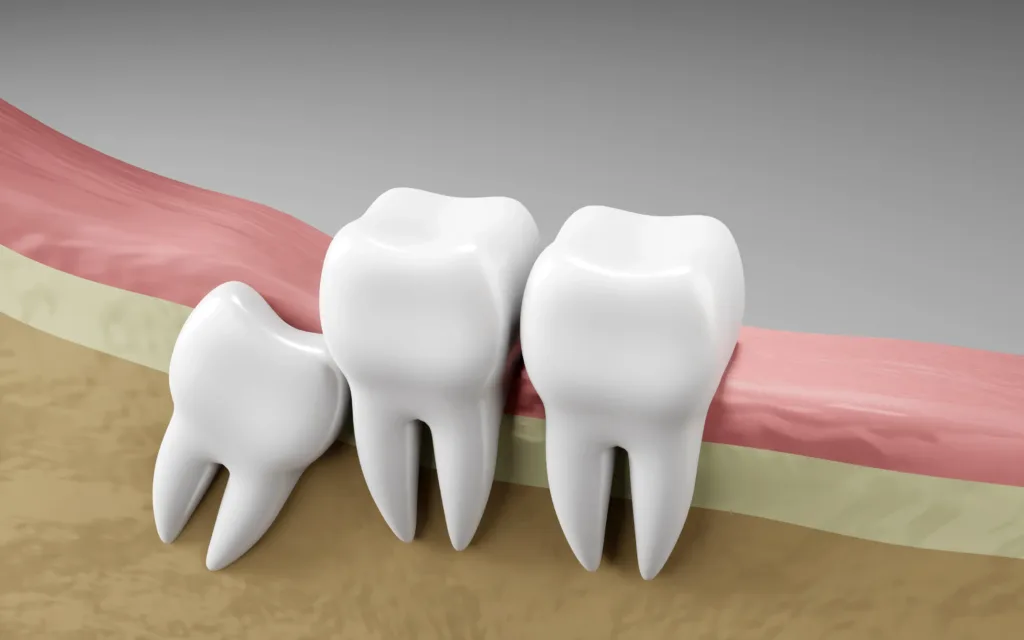 Extraction Dents de Sagesse Tanger | Intervention Sûre