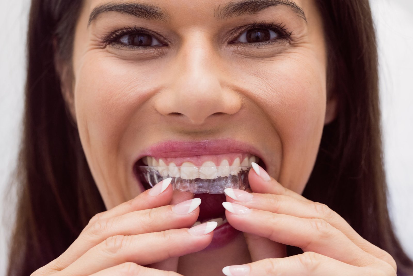 Transition vers Invisalign Tanger