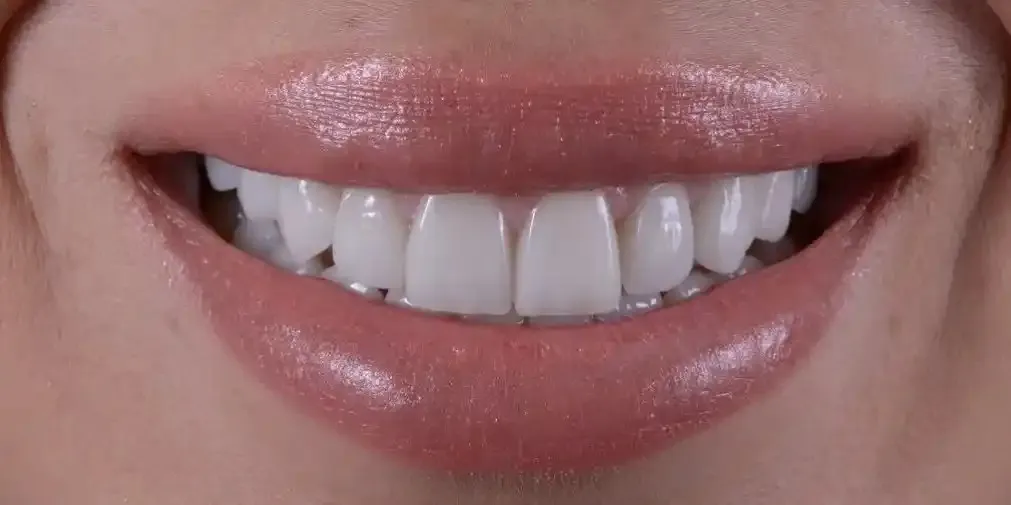 Sourire parfaitement aligné grâce aux gouttières invisibles à Tanger